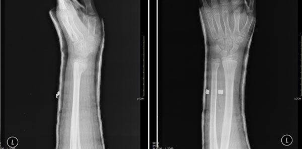 スミス骨折（1ｗ後）